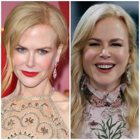 Nicole Kidman Sparks Plastic Surgery Rumors With Noticeably Swollen Face!