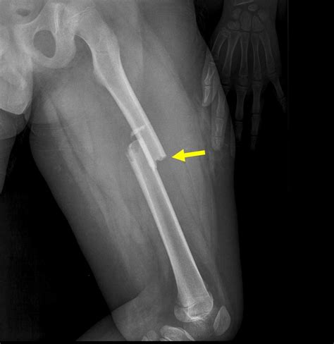 leg shortening after femur fracture