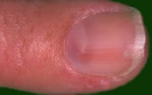 Glomus Tumor Nail Bed Symptoms - Nail Ftempo