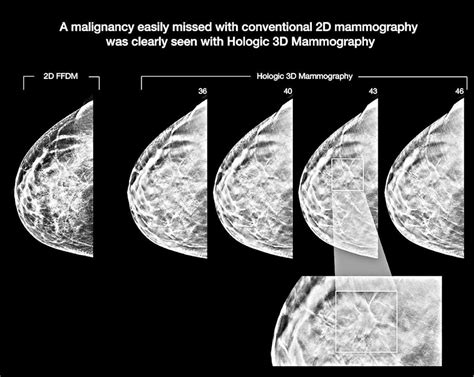 Mammograms Are Better In 3D – Family Medicine Center