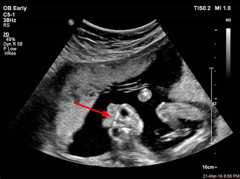 Anencephaly causes, symptoms, diagnosis, prognosis & anencephaly treatment