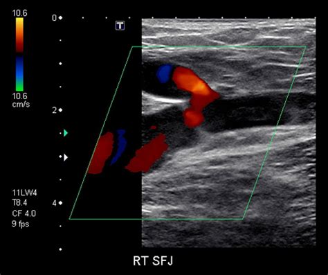 Vascular Ultrasound Study