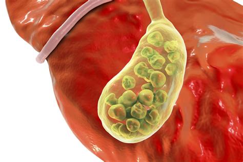 Gallbladder inflammation symptoms: Signs, complications, and causes