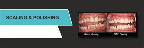 Scaling and polishing| Teeth whitening| Aastha dental care in Surat