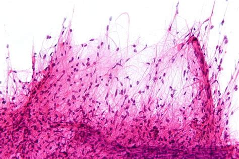 Pilocytic astrocytoma: the astrocytoma with good manners | Pathology ...