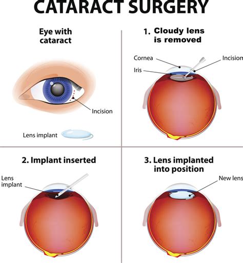 Eye Surgery for Cataracts, Pterygiums, Eyelid Lesions and Ptosis - ACE