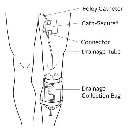 Caring for Your Urinary (Foley) Catheter | Memorial Sloan Kettering ...