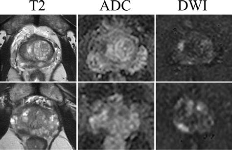 MRI images of suspected lesions in the prostate of the positive case ...