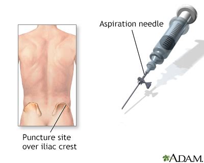 Bone marrow biopsy Information | Mount Sinai - New York