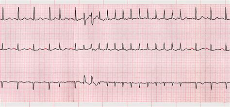 Ecg De Arritmias | Porn Sex Picture