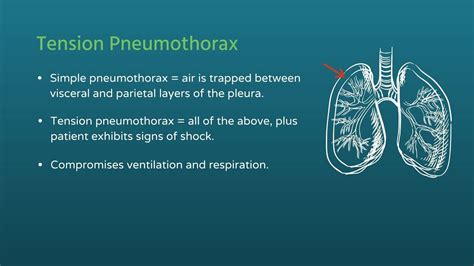 Chest Trauma: Tension Pneumothorax - YouTube