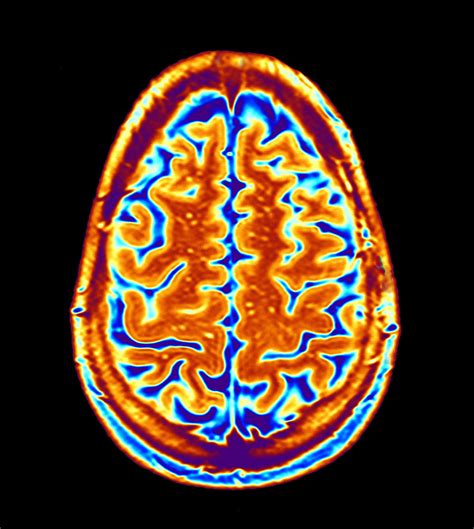 Autism: fMRI Brain Scans Can Predict Autism With 97% Accuracy | Time