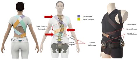 Scoliosis Brace