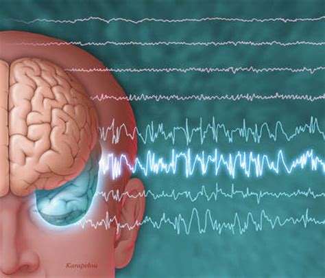 Stock Illustration - Illustration of a brain showing epileptic seizure ...