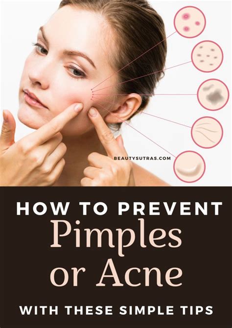 How to Prevent Pimples or Acne: Tips and Home Remedies - BeautySutras