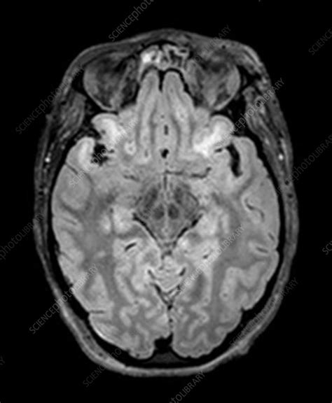 Severe Traumatic Brain Injury, MRI - Stock Image - C027/1723 - Science ...