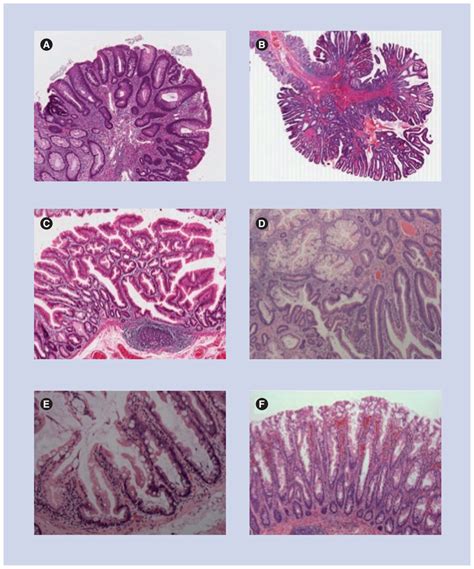 Polyp histological subtypes (A) Traditional adenoma. (B) Tubulovillous ...