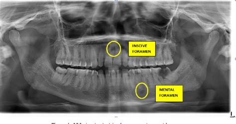 incisive foramen radiograph - live for today quotes tumblr