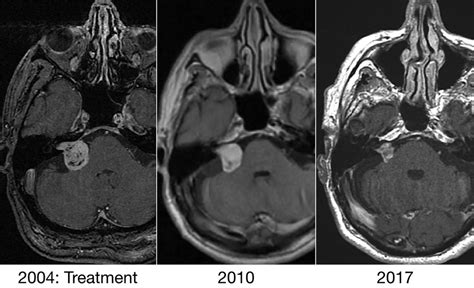 16 Gamma Knife Radiosurgery for Treatment of Sporadic Vestibular ...