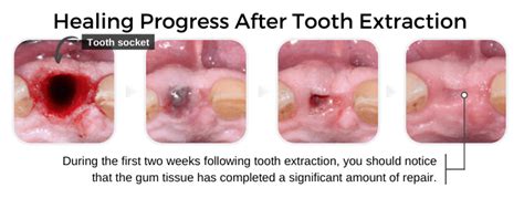 Tooth Extraction Aftercare (Instructions): The Dos & Don’ts