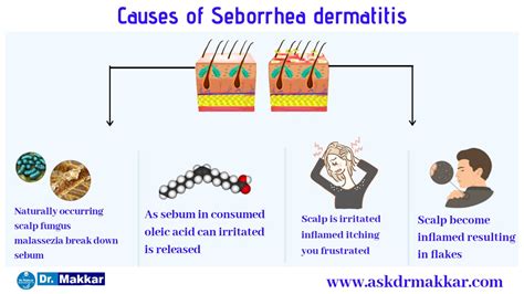 Seborrheic Dermatitis Causes And Prevention | Hot Sex Picture