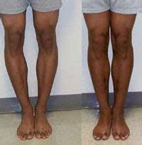 Realignment of Bowleg and Knock Knee Deformities