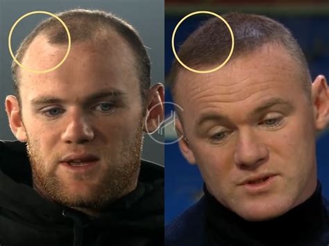 Wayne Rooney Hair Transplant - Hair Loss & Technical Analysis