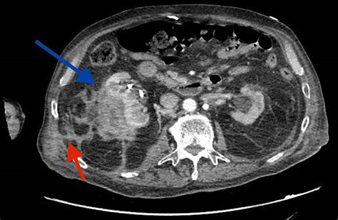 Perinephric Abscess Extending to the Psoas Muscle and Causing a Nephro ...