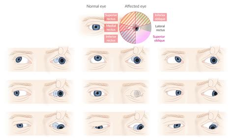 Causes For Strabismus: Cranial Nerve Palsy PinpointEyes, 41% OFF