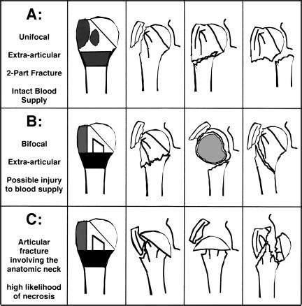 Types Of Proximal Humerus Fractures