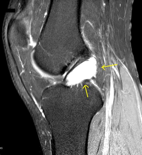 Ganglion Cyst of ACL-MRI - Sumer's Radiology Blog