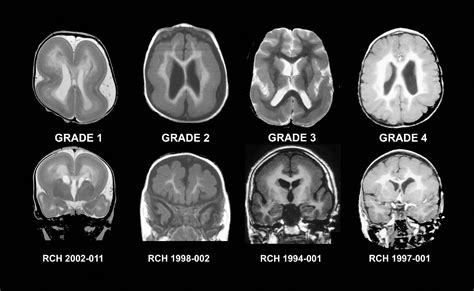 Abnormal Brain MRI | Mri Scan Images | Mri, Brain scan, Mri scan