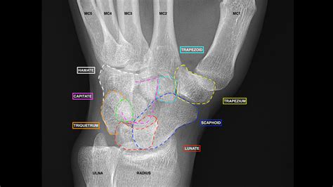 Lateral Wrist X Ray Labeled