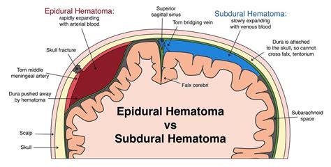 Epidural Hematoma | Epidural Hematoma Clinical Presentation