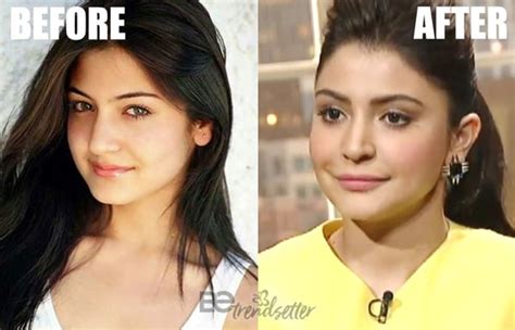 Anushka Sharma Before And After Surgery Images - the meta pictures