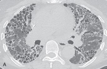 Cystic Lung Disease | Radiology Key