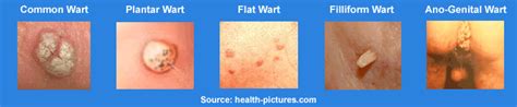 Warts Types, Symptoms, Treatment and Its Preventing Measures