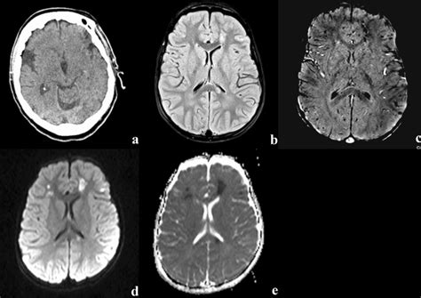 Patient with mTBI (GCS 14). CT scan does not demonstrate abnormalities ...