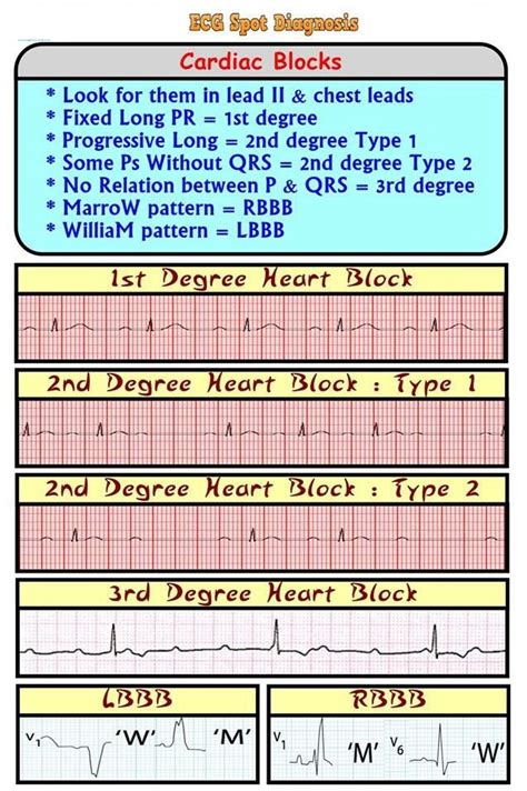 ECG/EKG Spot Diagnosis: Cardiac Rhythms Heart Blocks - NCLEX Quiz