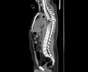 Chance fracture | Radiology Reference Article | Radiopaedia.org