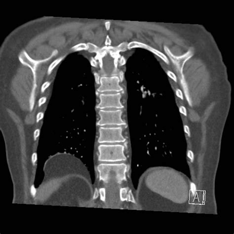 Bochdalek hernia | Radiology Reference Article | Radiopaedia.org