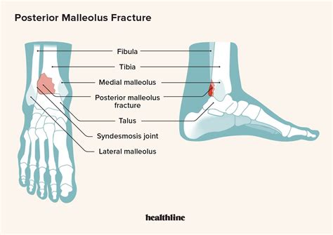 Posterior Malleolus Fracture: Definition, Treatment, and Recovery