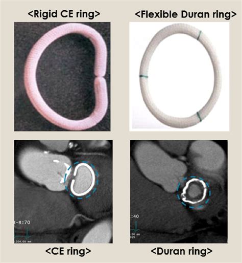 Figure 2 from Assessment of mitral annuloplasty ring by cardiac CT ...