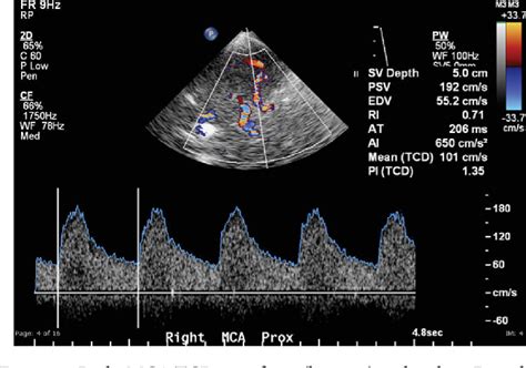 [PDF] Transcranial Doppler Ultrasound: A Review of the Physical ...