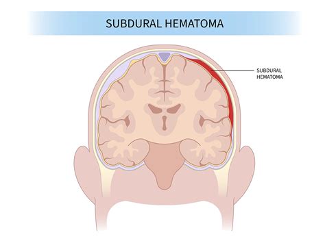 Subdural Hemorrhage: Causes, Symptoms & Treatment | Aurora Health Care