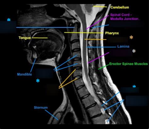 Cervical Mri Sagittal Diagram Quizlet | The Best Porn Website