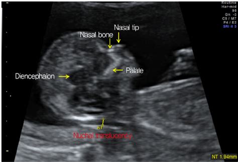 Measurement of nuchal translucency (NT) and other landmarks. | Download ...