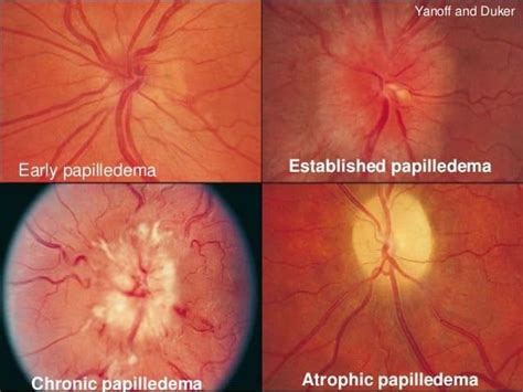 Papilledema #IIH