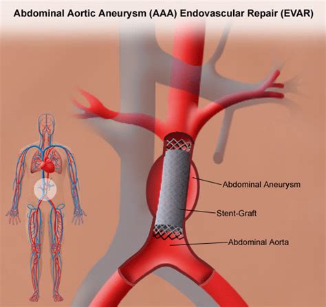 Endovascular aneurysm repair (EVAR) | Stanford Health Care