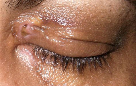 xanthelasma removal surgery